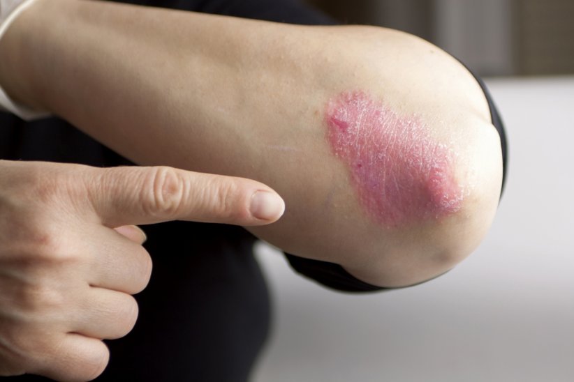 Le psoriasis Le psoriasis
