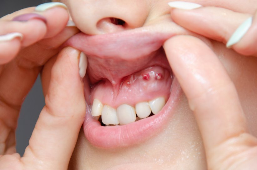 Des infections liées à des maladies bucco-dentaires Des infections liées à des maladies bucco-dentaires