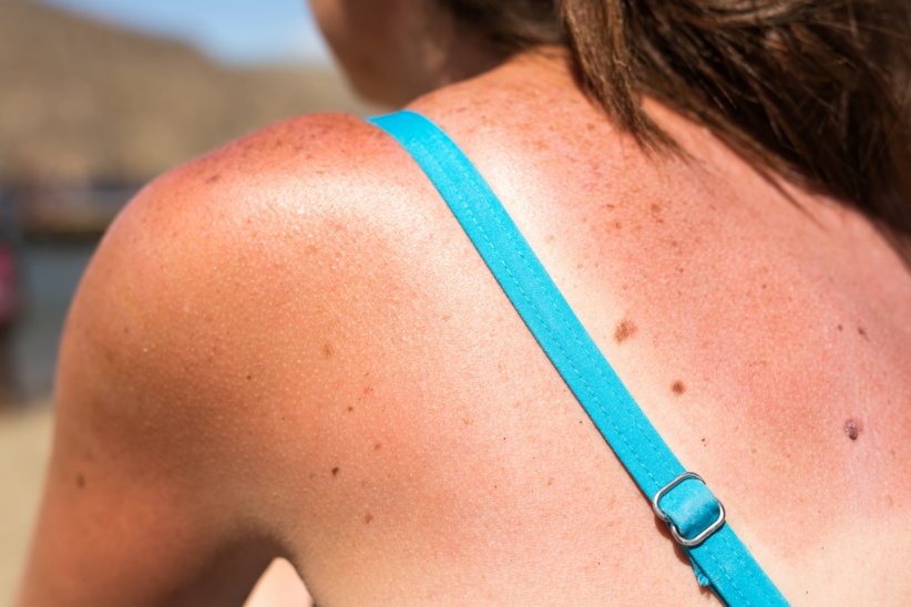 Un coup de soleil Un coup de soleil