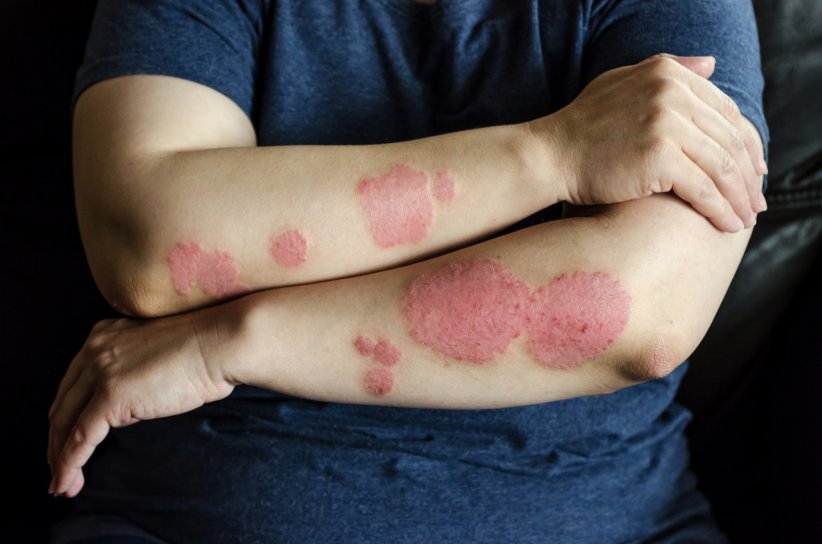 Le psoriasis Le psoriasis