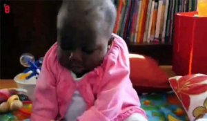 Une petite fille née avec 4 jambes, opérée avec succès