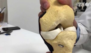 Rennes. Une nouvelle approche moins invasive pour la prise en charge de certaines ruptures du ligament croisé antérieur du genou.