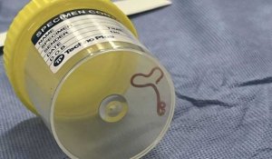 Un ver parasite extrait vivant d'une patiente australienne de 64 ans