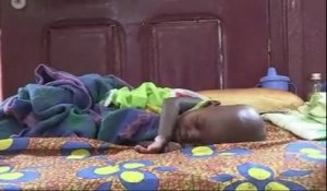 Bangui: plusieurs cas grave de malnutritions infantile