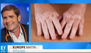 Le vitiligo, qu'est-ce que c'est ?