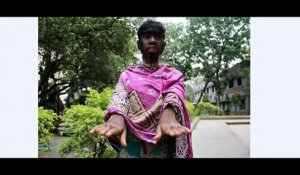 Une fillette atteinte du «syndrome du loup-garou» au Bangladesh