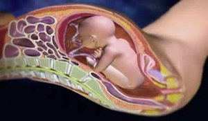 L'accouchement par césarienne expliqué en vidéo