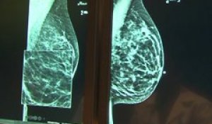 Cancer du sein: 70% des patientes pourraient éviter la chimiothérapie, selon une étude