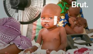 Au Tchad, un hôpital construit en urgence pour faire face à la malnutrition aiguë sévère