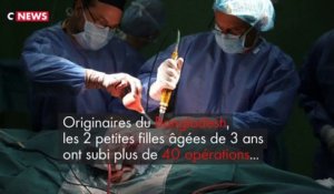 Après 30 heures d'opération, 2 fillettes siamoises reliées par la tête ont été séparées