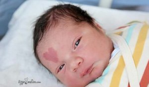 Cet enfant est né avec une tâche de naissance en forme de cœur, voici à quoi il ressemble 5 ans plus tard