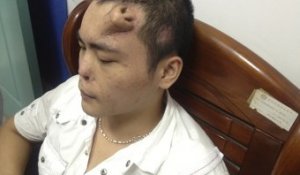 Chine : des médecins font "pousser" un nez sur le front d'un patient