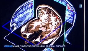 Un test sanguin pour dépister Alzheimer