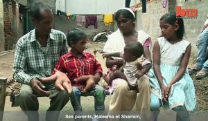 Un enfant de 8 ans aux mains géantes en Inde