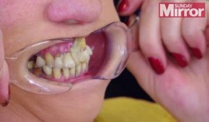 Une femme se colle les dents avec de la super glue