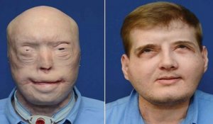 L'incroyable métamorphose du visage de Patrick Hardison, le pompier brûlé au 3ème degré après sa greffe du visage