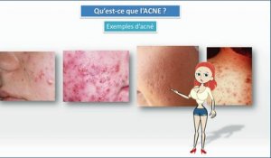 Lily James: L’acné est une vraie souffrance"