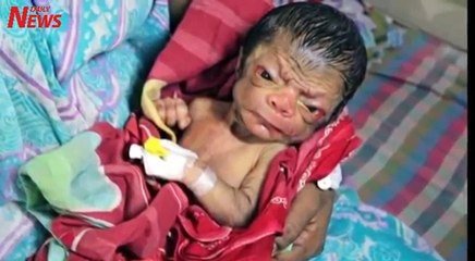 Un Bebe Vient Au Monde Avec L Apparence D Un Vieux De 80 Ans