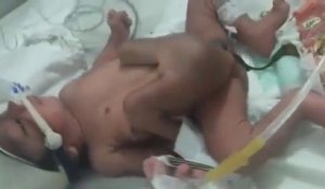 Un bébé nait avec 4 jambes et 2 pénis