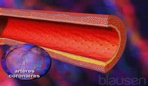 L'infarctus du myocarde expliqué en vidéo