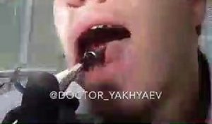 Ce dentiste russe s'arrache une dent de sagesse et poste la vidéo sur instagram
