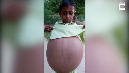 Cet enfant Pakistanais a le ventre gonflé à cause d'une maladie rare