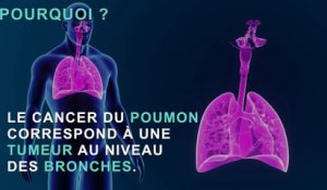 Cancer du poumon : les symptômes d'alerte