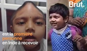Une petite fille de 4 ans reçoit une greffe du crâne en Inde