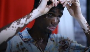 Ce mannequin nous prouve que le vitiligo n'est pas un problème