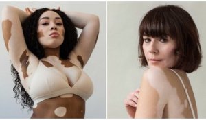 Une séance photo en « ode à la beauté et à l'unicité » du vitiligo prise par une photographe elle-même atteinte