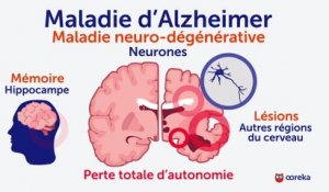 Alzheimer : symptômes, facteurs de risque, traitements